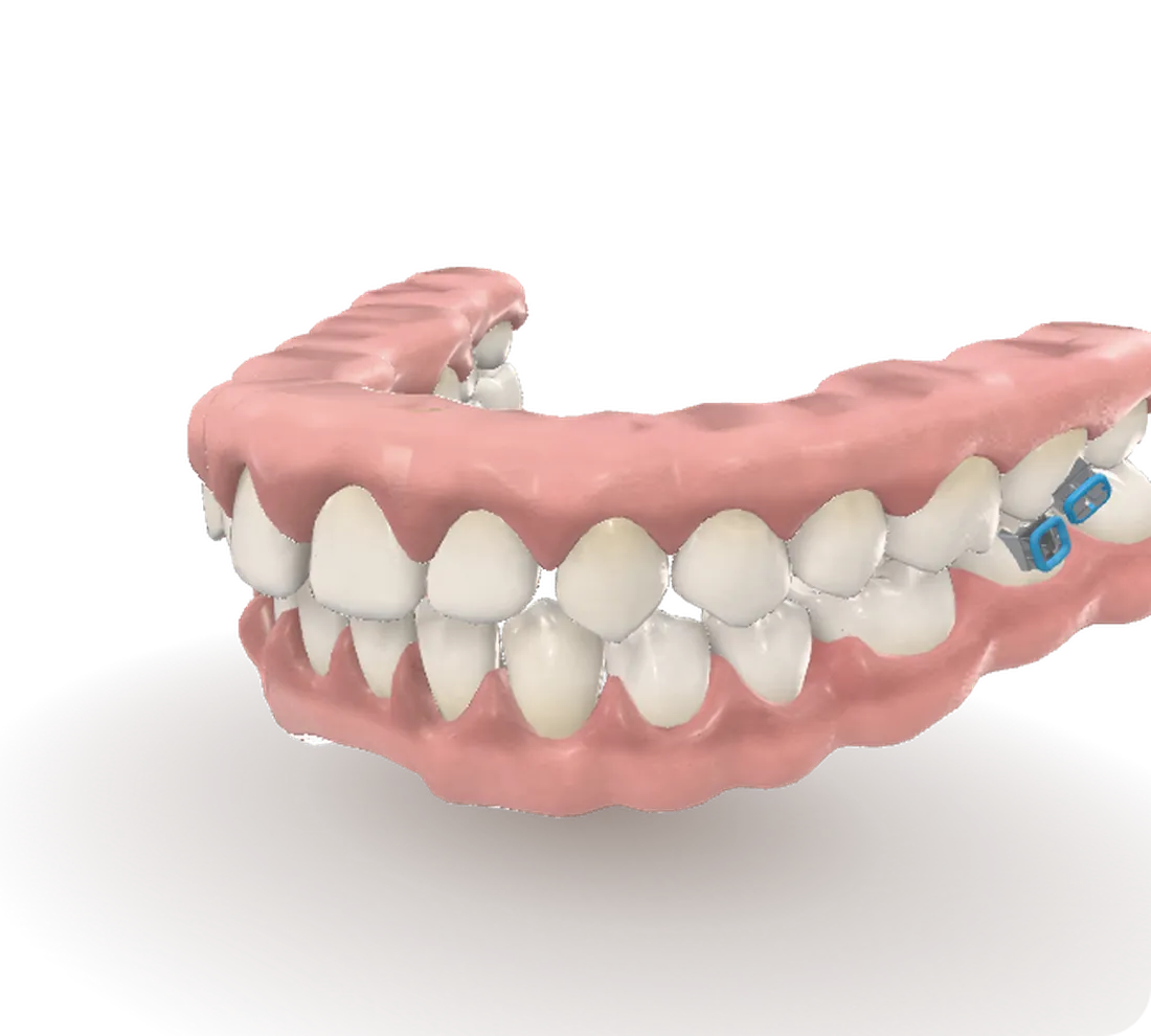 Dentition en 3D avec des bagues multi-attaches